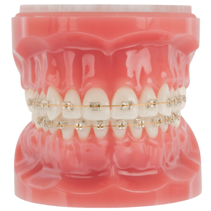 crystal clear ortho lightforce braces